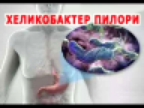 ★Как избавиться от ХЕЛИКОБАКТЕР ПИЛОРИ. Схема терапии. Медикаментозное лечение и народные методы. 